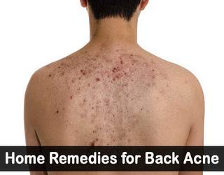 How to heal acne with natural methods