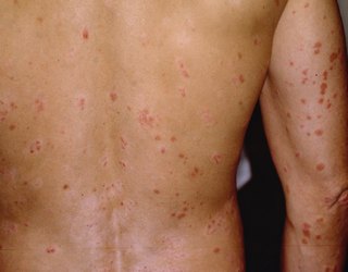 Fear of getting healed - Psoriasis