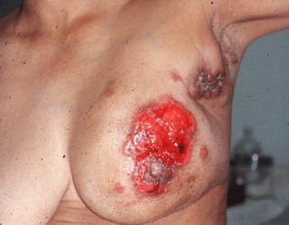 breast cancer