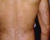 Fear of getting healed - Psoriasis