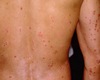 Psoriasis and new accelerated healing technique